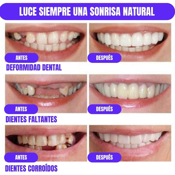 DentalClean® Carillas de Resina para una Sonrisa Natural 2X1